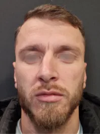 AN Rhinoplasty Before