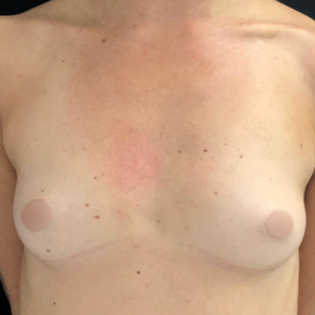 Cadogan Clinic LDL Breast Augmentation Before