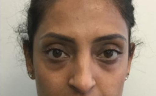EH Before Lower Blepharoplasty