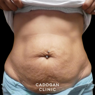 Cadogan Clinic PT Abdo Before