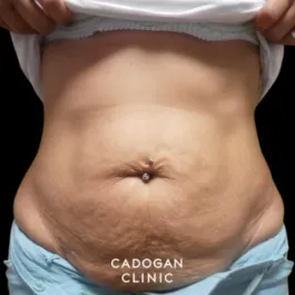 Cadogan Clinic PT Abdo Before