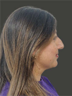 AN Rhinoplasty Before