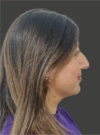 AN Rhinoplasty Before