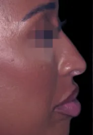 MA Rhinoplasty Before Side