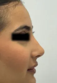 MA Septorhinoplasty After Side