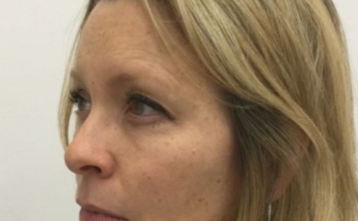Unknown Before Upper Blepharoplasty Three Quarters