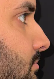 SP Before Rhinoplasty