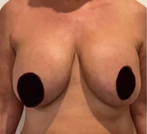 GG Before Mastopexy Front