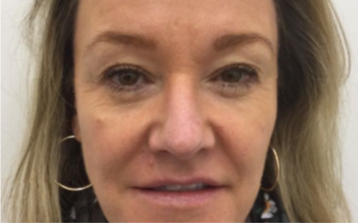Unknown Before Upper Blepharoplasty