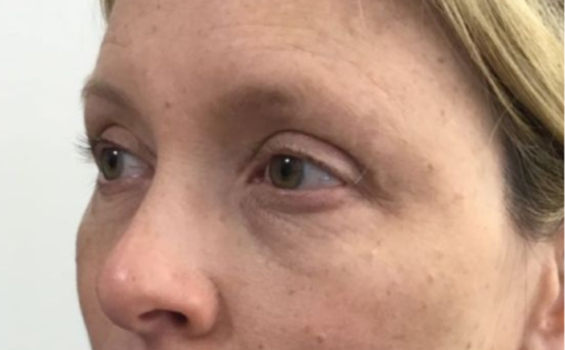 Unknown After Upper Blepharoplasty Three Quarters