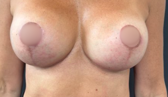 WVN After Mastopexy & Implant Exchange Front