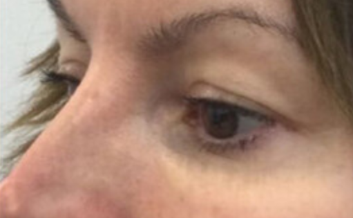 EH Before Upper Blepharoplasty