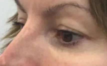 EH Before Upper Blepharoplasty