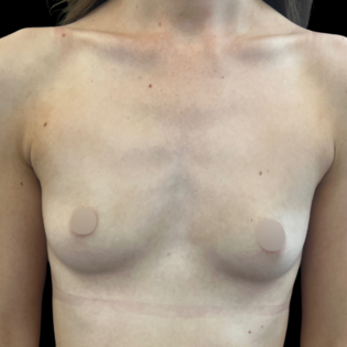 Cadogan Clinic MK Breast Augmentation Before