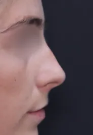 TJ Septorhinoplasty Before Side