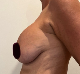 GG Before Mastopexy Side
