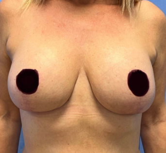 GG After Mastopexy Front