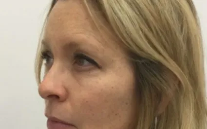 Unknown Before Upper Blepharoplasty Three Quarters