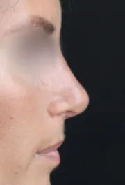 TJ After Rhinoplasty