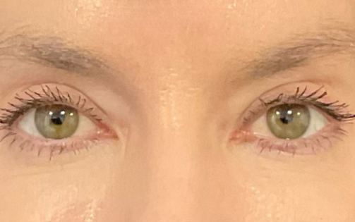KY After Upper Blepharoplasty Front