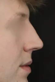 TJ Before Rhinoplasty