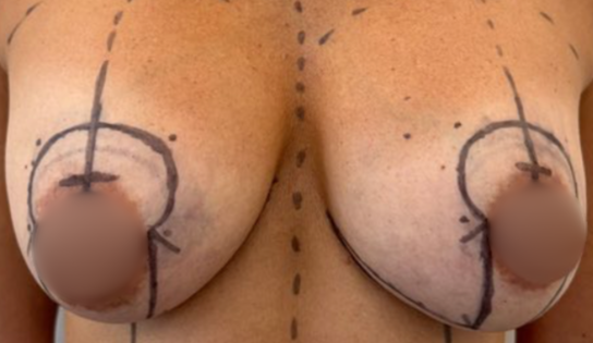 WVN Before Mastopexy & Implant Exchange Front