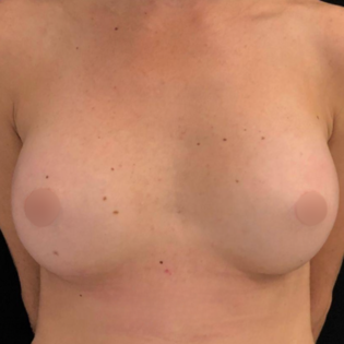 LDL Breast Augmentation After