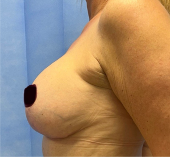 GG After Mastopexy Side