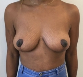 Unknown After Mastopexy