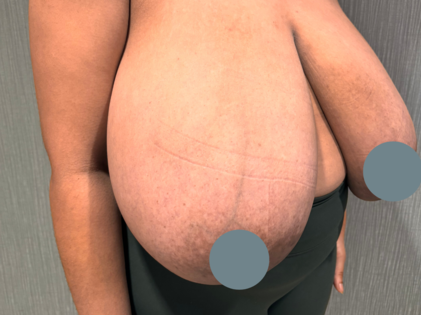 SSJ Breast Reduction Before