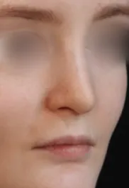 TJ After Septorhinoplasty Three Quarters View