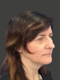 AN Rhinoplasty Before