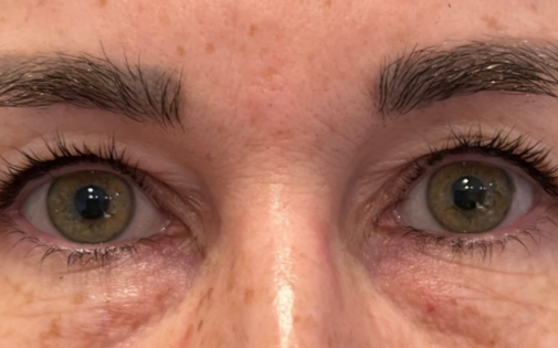 EH Before Upper Blepharoplasty