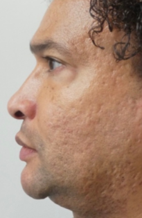 PT Before Nose Tip Rhinoplasty