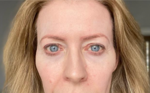 EH After Upper Blepharoplasty