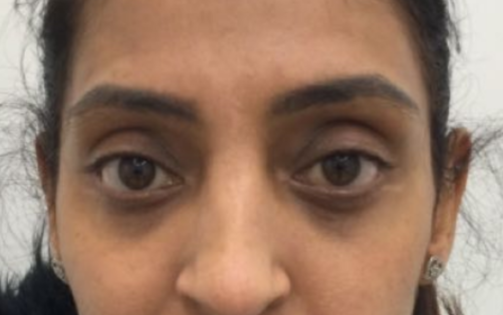 EH After Lower Blepharoplasty