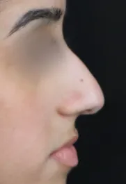 TJ Before Septorhinoplasty Profile