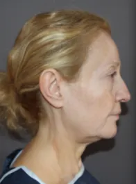 TT Before Face and Neck Lift, Bleph and Fat Transfer