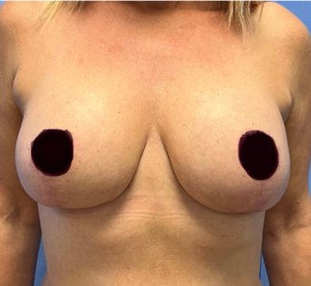 GG After Mastopexy Front