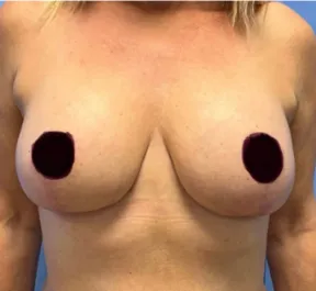 GG After Mastopexy Front