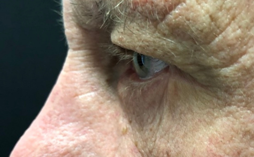 GG After Male Lower Blepharoplasty