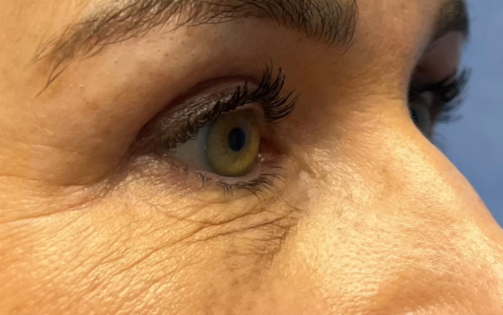 GG After Upper Blepharoplasty Three Quarters