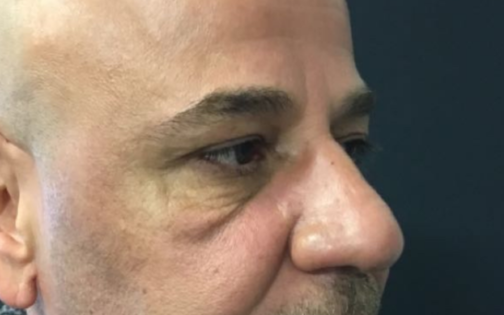 EH Before Male Lower Blepharoplasty