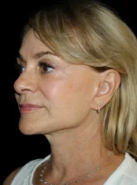 SC After Face and Neck Lift