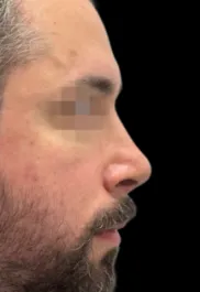 MA Septorhinoplasty After Side