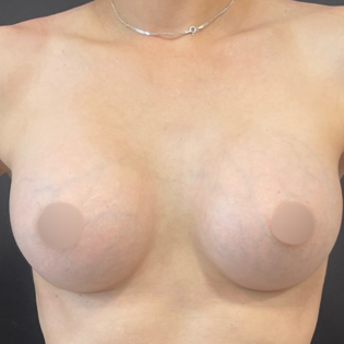 Cadogan Clinic WS Breast Augmentation After