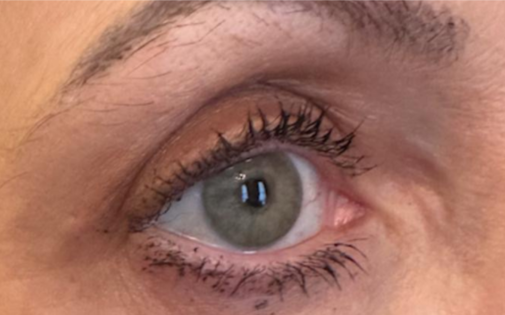 RR After Upper Blepharoplasty