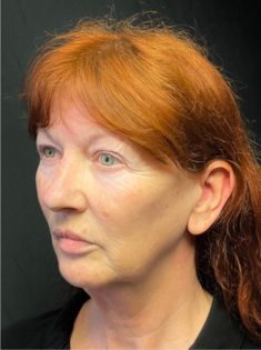 KY Before Deep Plane Face and Neck Lift, Brow Lift, Lip Lift, Bleph & Fat Transfer