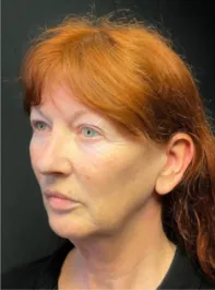 KY Before Deep Plane Face and Neck Lift, Brow Lift, Lip Lift, Bleph & Fat Transfer