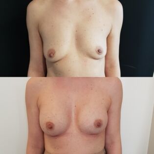 Ballerina Breast Augmentation Before and After
